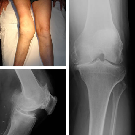 osteoarthritis knee lump