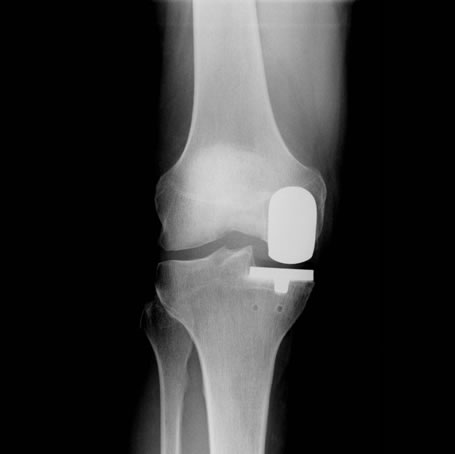 Uni-compartmental Knee Replacement