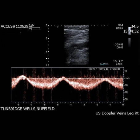 Venous Thrombo-Embolism